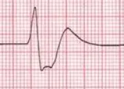 Quiz SMA Sleep Quiz (EKG)