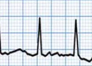 Quiz SMA Sleep Quiz (EKG 2)