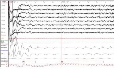 Identify the Apnea