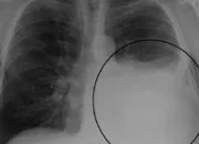 Quiz Chest Radiography-Pathology