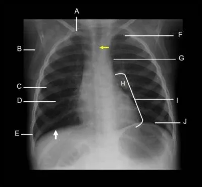 Whick letter illustrates the Aortic Arch?